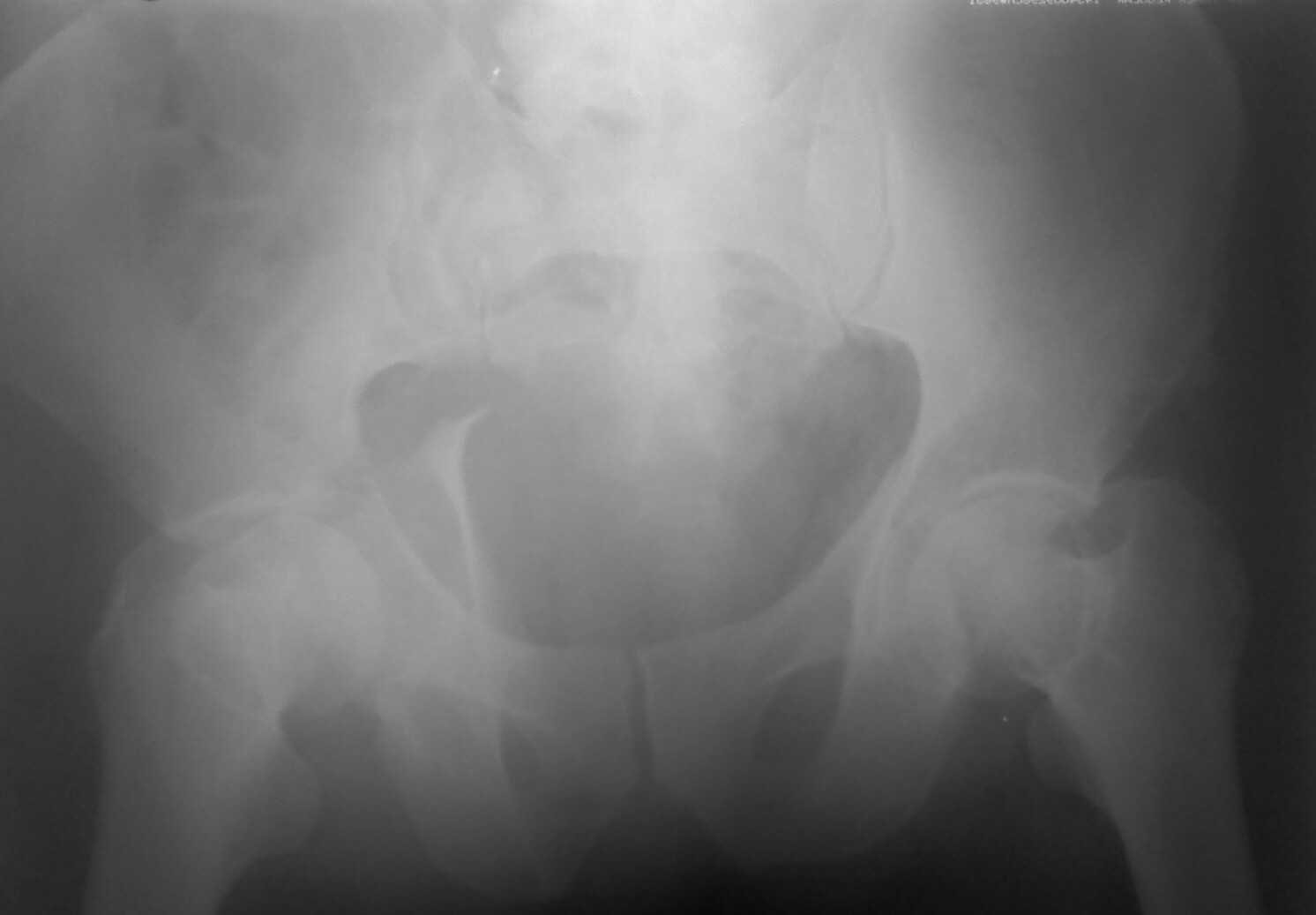 Перелом вертлужной впадины рентген