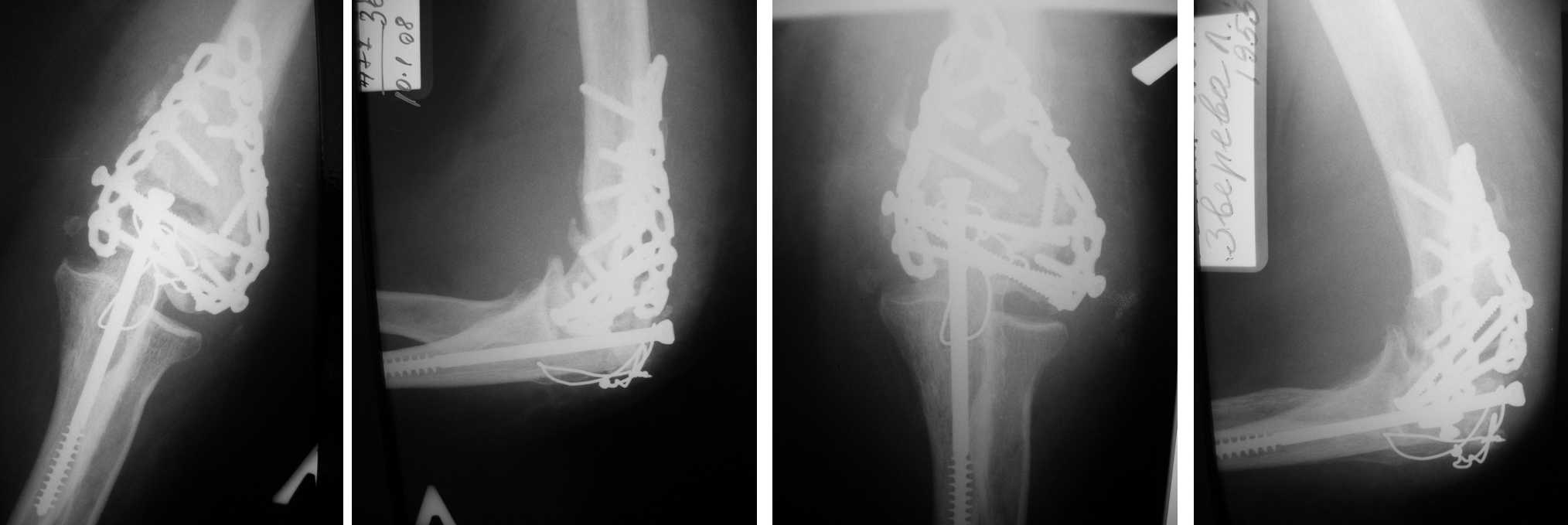 Раздробленная кость рентген