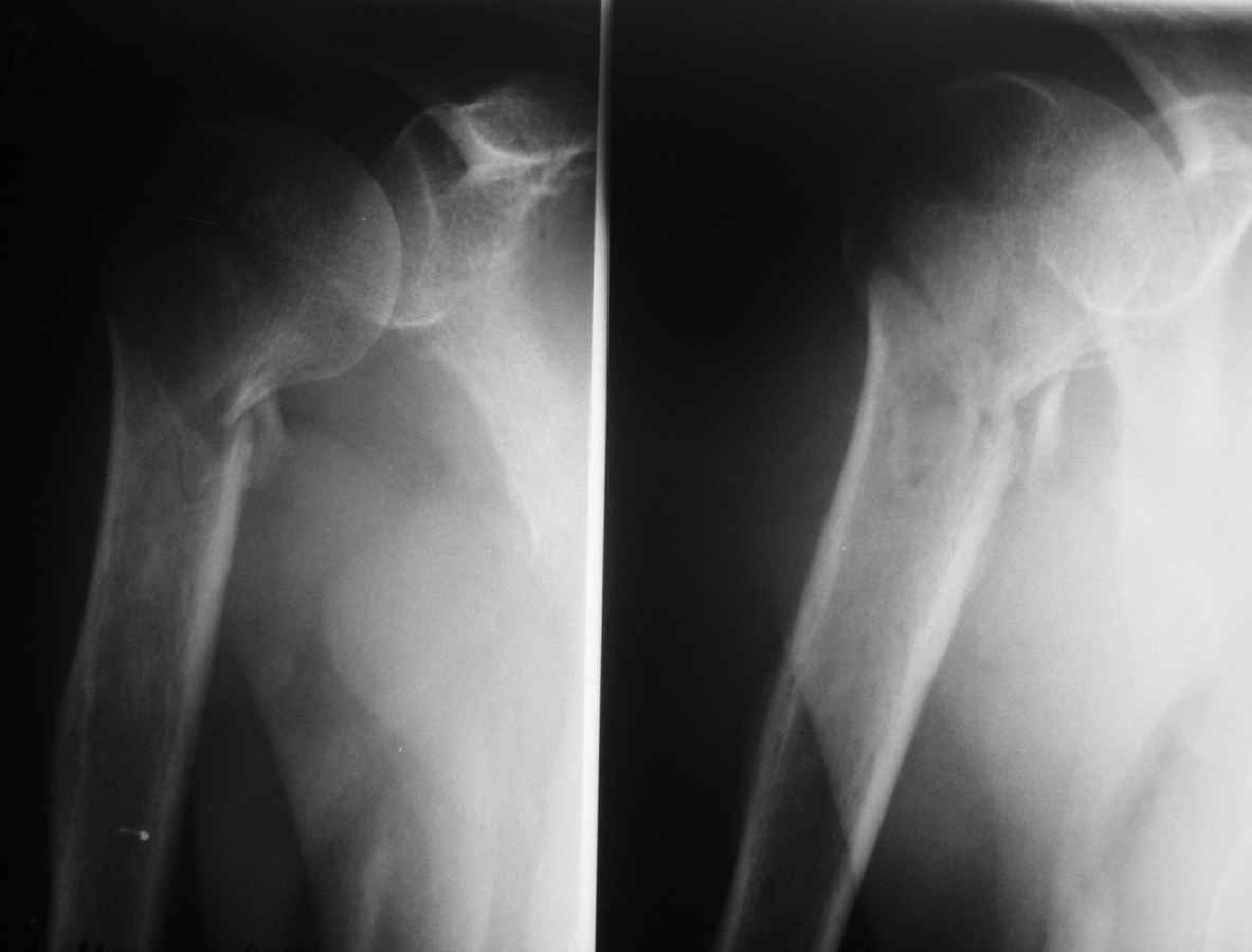 Вколоченный перелом хирургической шейки плеча рентген