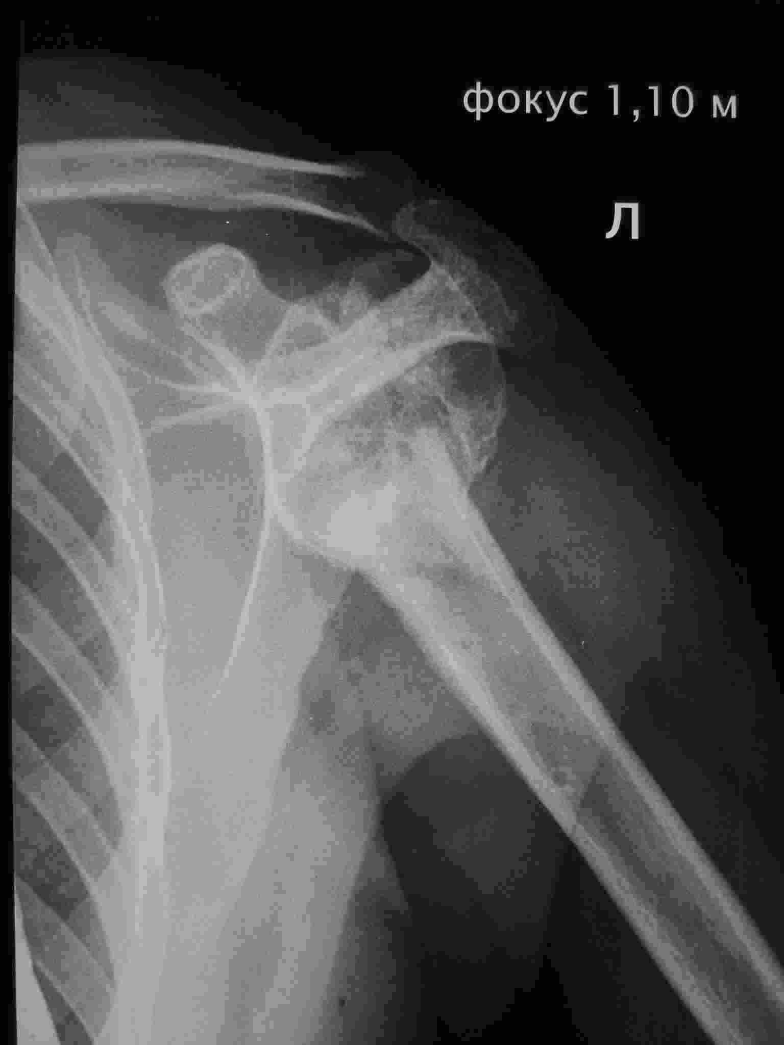 Плечевой сустав перелом шейки рентген