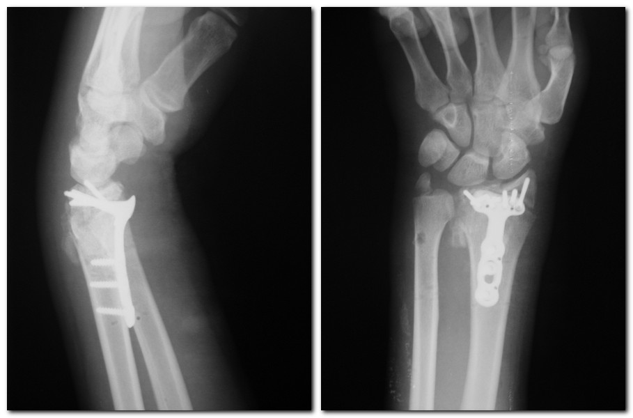 Перелом лучевой кости руки без смещения фото возле кисти